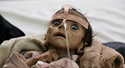 Yémen: un enfant mort de faim, symbole de l’indifférence générale

