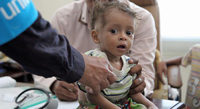 Yémen: plus d’un million d’enfants dénutris sous la menace du choléra
