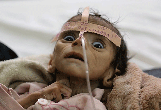 Yémen: un enfant mort de faim, symbole de l’indifférence générale

