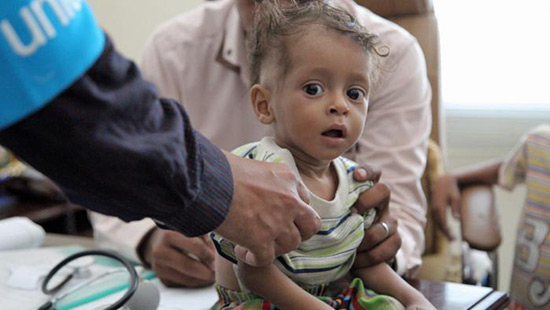 Yémen: plus d’un million d’enfants dénutris sous la menace du choléra
