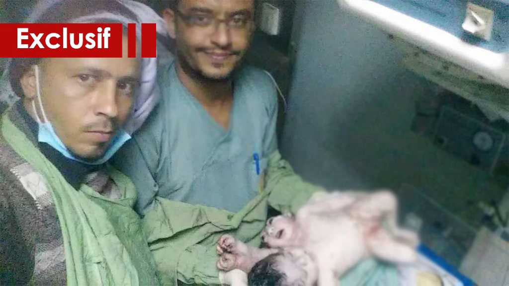 Deux jumeaux siamois morts à Sanaa loin des médias occidentaux