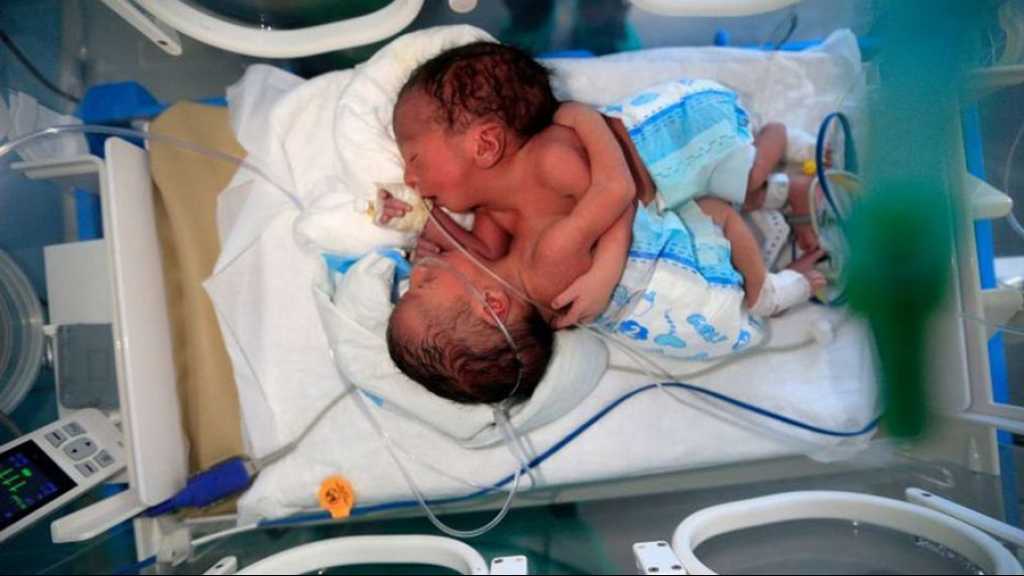 Yémen: dans un état critique, deux bébés siamois attendent une opération à l’étranger