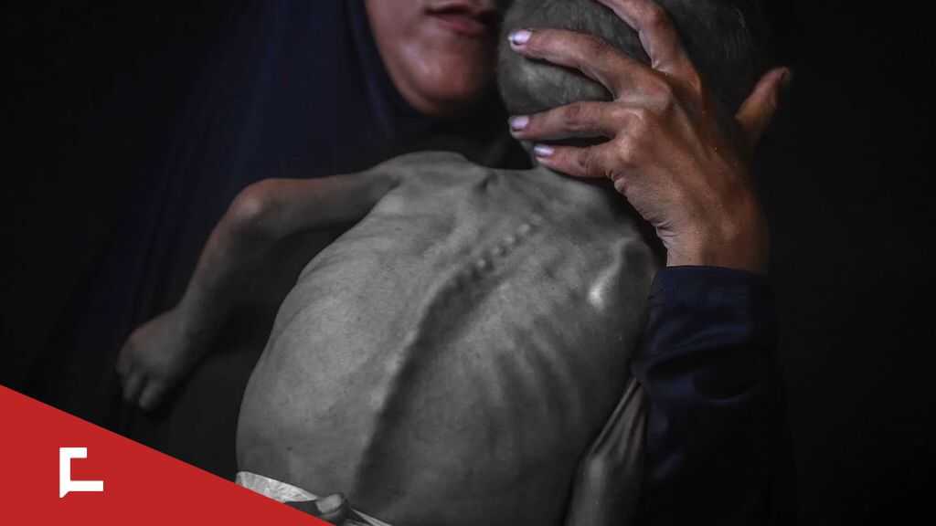 Gaza: Un record des enfants souffrant de malnutrition aiguë enregistré en juillet